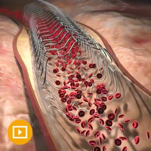 Oakstone Comprehensive Review of Interventional Cardiology 2023