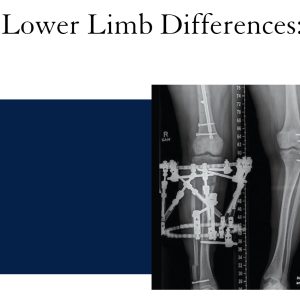 UCSF Managing Children with Lower Limb Differences An Integrated Approach 2022