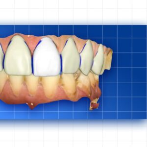 OHI-S Complete prosthetic protocols CADCAM CEREC