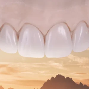 OHI-S Fixed Prosthetic Restorations common mistakes and advanced solutions