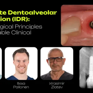 OHI-S Immediate Dentoalveolar Restoration (IDR) From Biological Principles to Predictable Clinical Outcomes 4 lessons 2h 43min